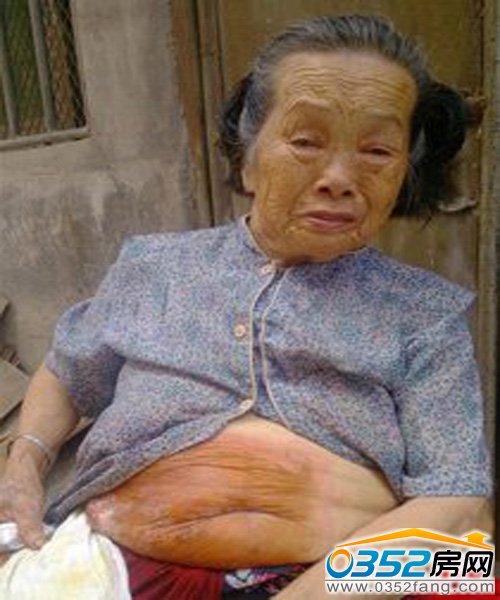 79歲胡阿婆肚子一部分潰爛 每夜難以入睡 兒孫無人給治